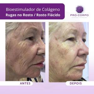 rugas